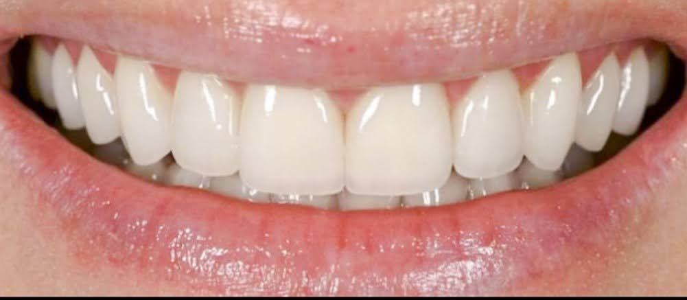 After Porcelain Veneers