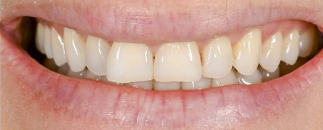 Before Porcelain Veneers