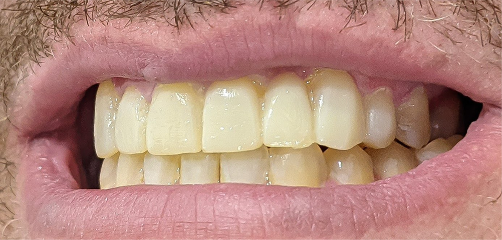 After Composite Bonding & Crowns