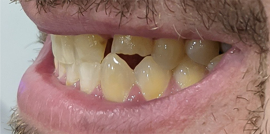 Before Composite Bonding & Crowns