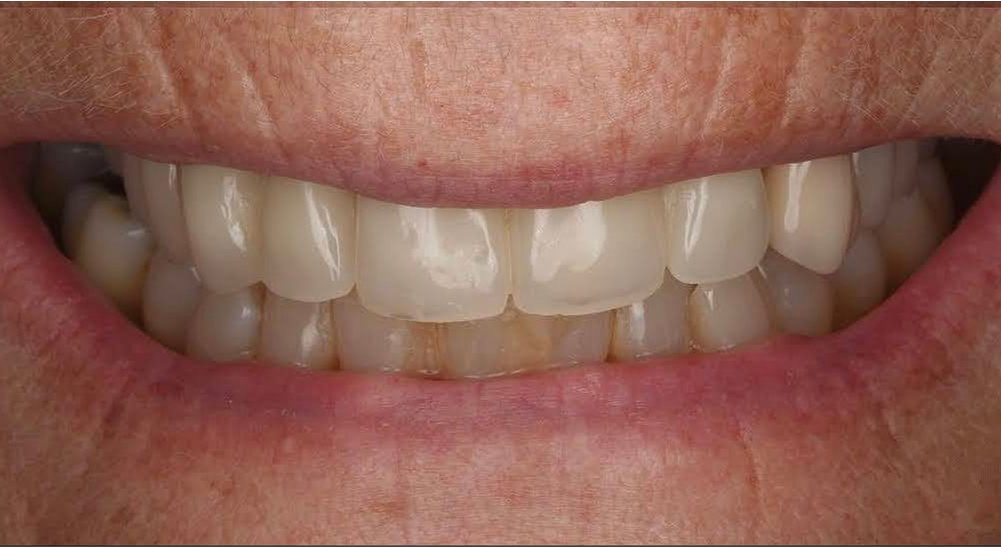 After In-Office Whitening