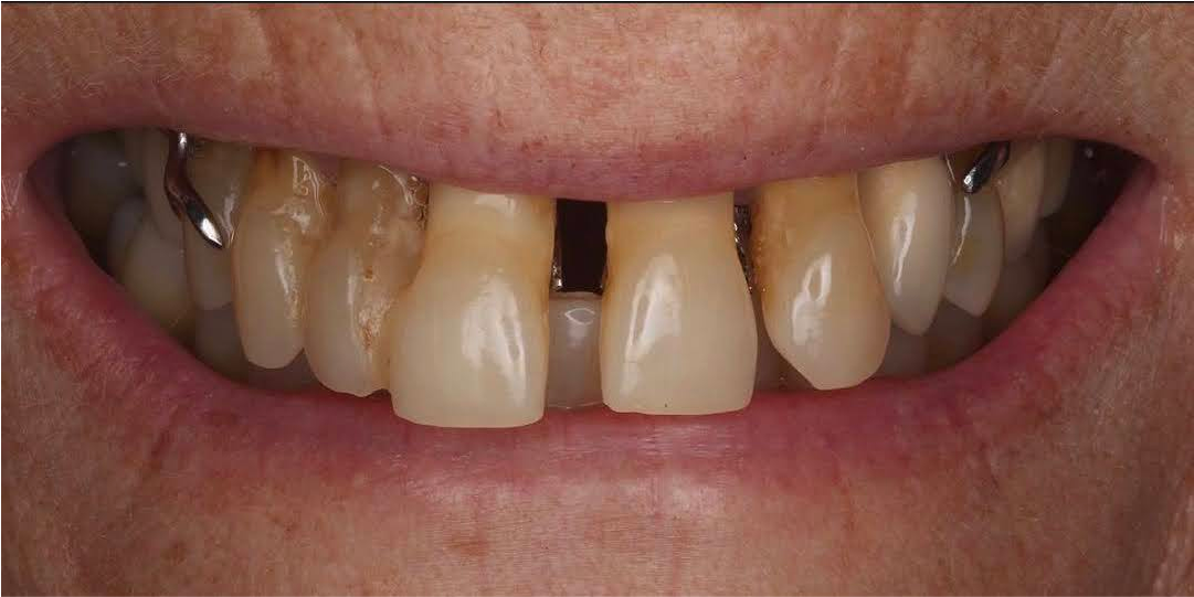 Before In-Office Whitening